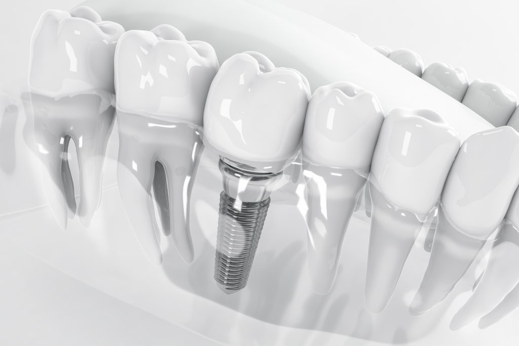Dental İmplantlar Hakkında Bilmeniz Gereken Her Şey