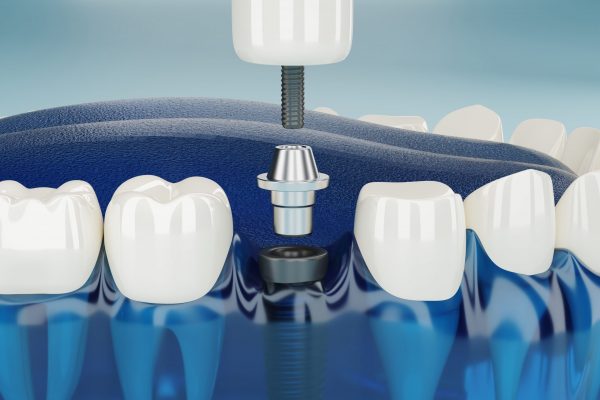 malatya implant